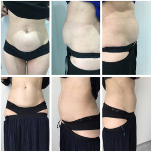 Before and After Tummy Fat Removal at G&T Aesthetics