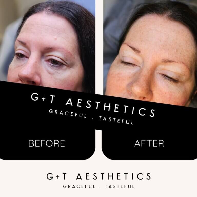 Before & After PRP Bio Filler Treatment at G&T Aesthetics
